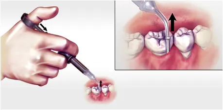 Hand holding dental tool and inserting into gums